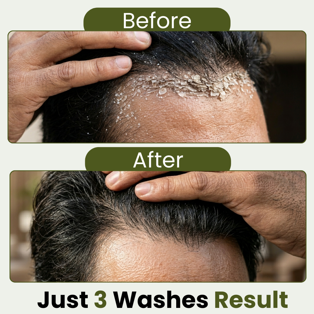 Organic Herbal Anti-Dandruff Shampoo (250ml)