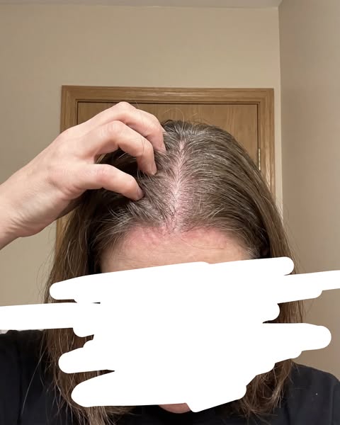Dry & Lifeless Hair