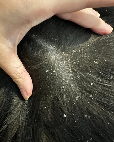 Persistent Dandruff