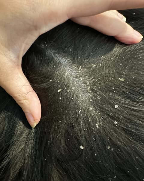Persistent Dandruff