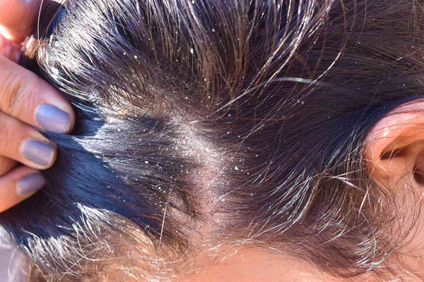 Itchy & Unhealthy Scalp